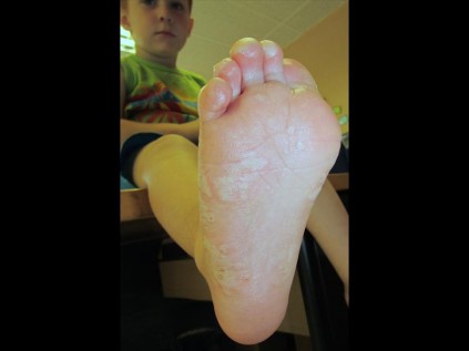Anthony Snyman (2) shows his foot covered in blisters after unknowlingly stepping on live coals covered in sand on Tuesday