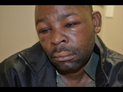 The swollen face of Thami Madlala the day after his alleged brutal attack by the police