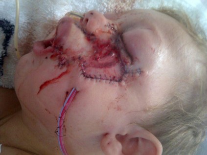 Sebastian's face after receiving a total of 134 stitches following the dog attack