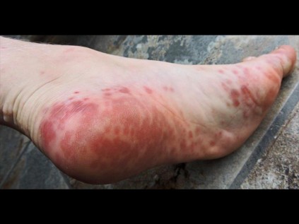 Small red dots on his hands and feet soon developed into blisters and ulcers