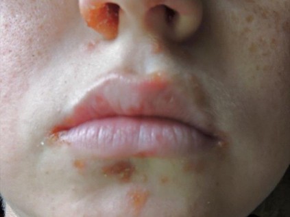 Painful and highly contagious, the effects of the Coxsackie virus are clearly seen on Reagan’s face