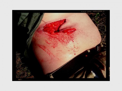 The buffalo horn pierced Andrew’s abdomen, breaking three ribs and injuring his kidney