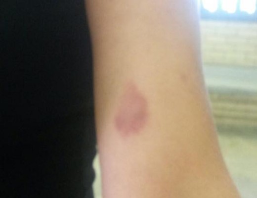 A photo of the woman's bruised arm was uploaded to Meerensee Crime Watch's Facebook page. 