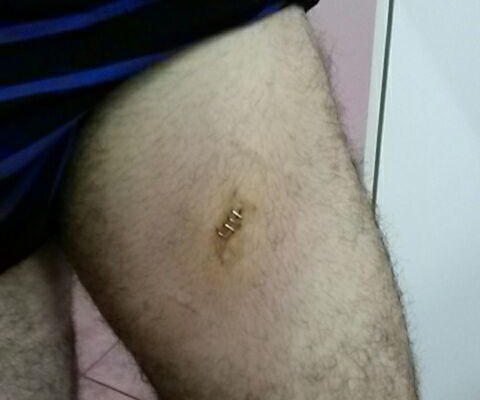 This stab wound just missed the femoral artery
